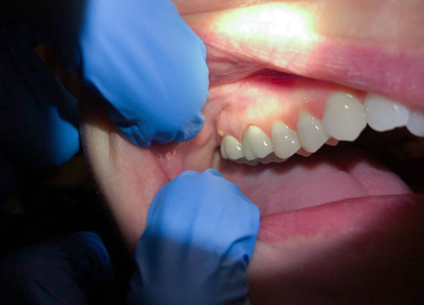 Best Dental Abscess Treatment in Perham, MN